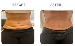 Body Before and After Cryoslimming Treatment