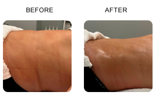 Body Before and After Post-Surgery Treatment